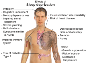 השפעות העדר שינה. מקור: ויקיפדיה. מאת:Mikael Häggström