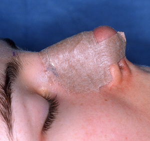 ניתוחים פלסטיים באף. מקור: ויקיפדיה. ברשיון cc3-by. מאת: Steve Denenberg