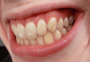 בריאות השיניים והחניכיים. מקור: ויקיפדיה. ברשיון CC3-by-sa. מאת: Josconklin