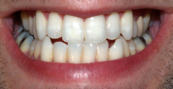 שיניים. מקור: ויקיפדיה ברשיון CC3-by-sa צילום: David Shankbone