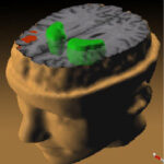 הדמיית צילום מוח של חולי סכיזופרניה. מקור: ויקיפדיה ברשיון חופשי לשימוש. איור באדיבות המכון הלאומי לבריאות בארה