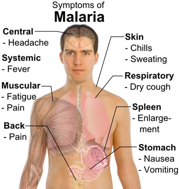 תסמיני מחלת המלריה. מקור: ויקיפדיה ברשיון חופשי. מאת: Mikael Häggström