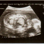 בדיקת אולטרסאונד לבחינת התפתחות העובר בהריון. מקור: ויקיפדיה ברשיון cc3-by-sa. צילום: Nevit Dilmen