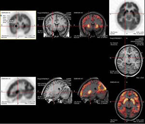 סריקת מוח- PET. מקור: ויקיפדיה ברשיון שימוש חופשי. מאת: Mco44