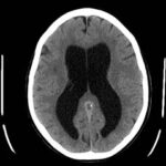 סריקת CT מוח של חולה. מקור: ויקיפדיה ברשיון -cc3-by-sa. צילום: Lucien Monfils