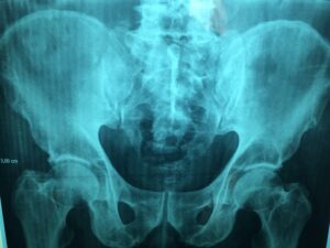 X RAY צילום רנטגן צפיפות עצם. השפעת שורש מאקה על אסטרוגן וצפיפות העצם. צילום: PIXABAY Dr Manuel González Reyes