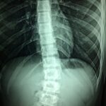 פריצת דרך. שיקום פגיעת עמוד שדרה בטיפול ייחודי. צילום: Pixabay Dr. Manuel González Reyes